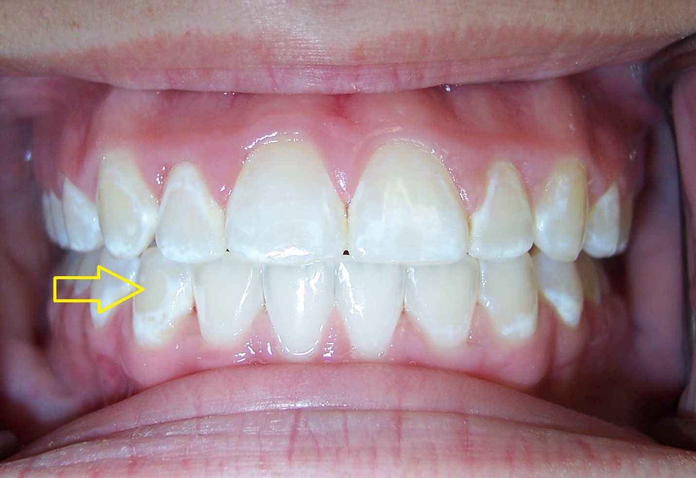 لک دندان بعد از ارتودنسی