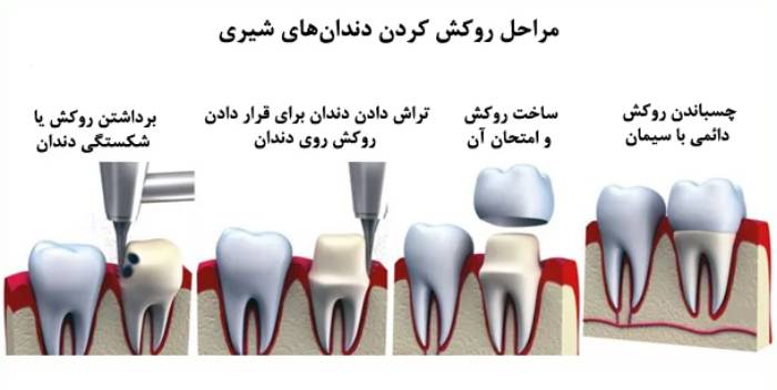 مراحل انجام روکش دندان شیری