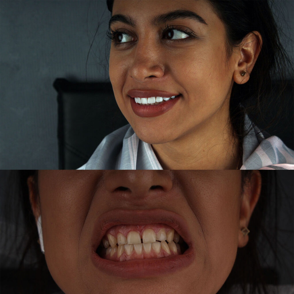  کامپوزیت دندان 
