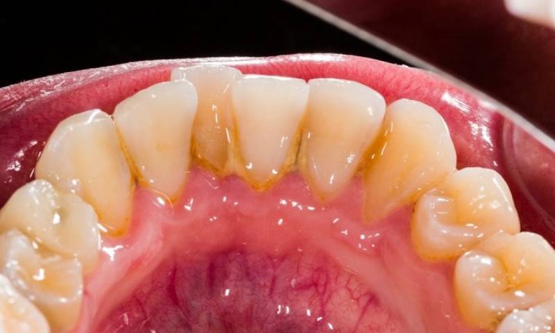 انواع جرم دندان