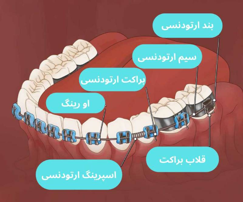 اجزای ارتودنسی دندان