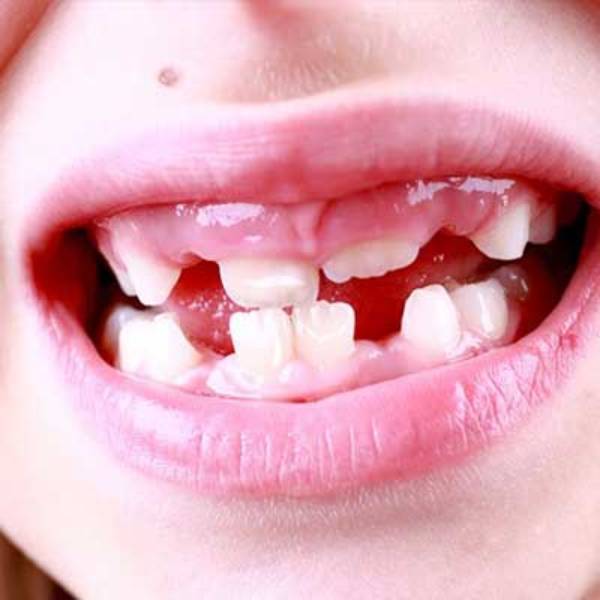 دندان شیری