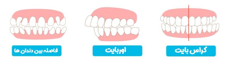 انواع مال اکلوژن دندان