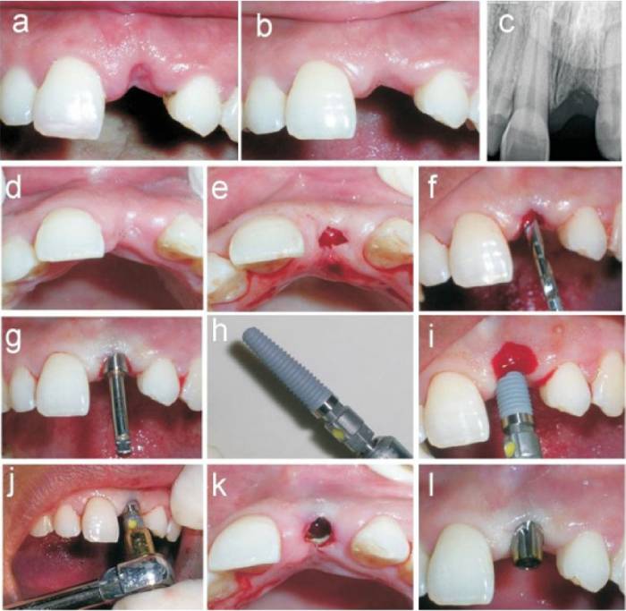 مراحل ایمپلنت فوری دندان