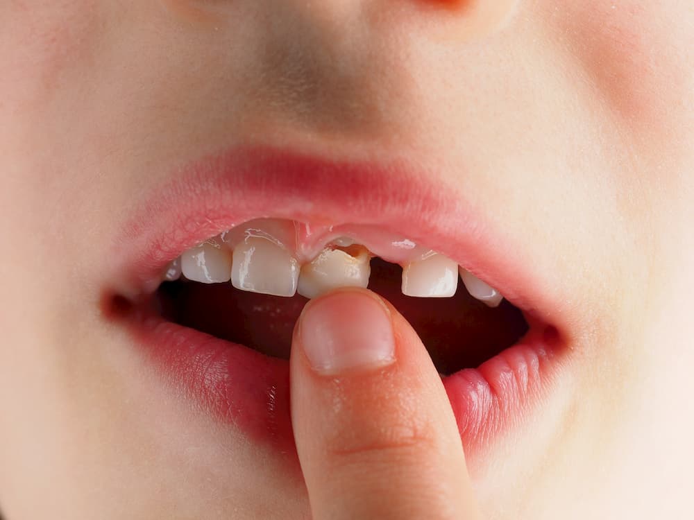 تروما دندان چیست