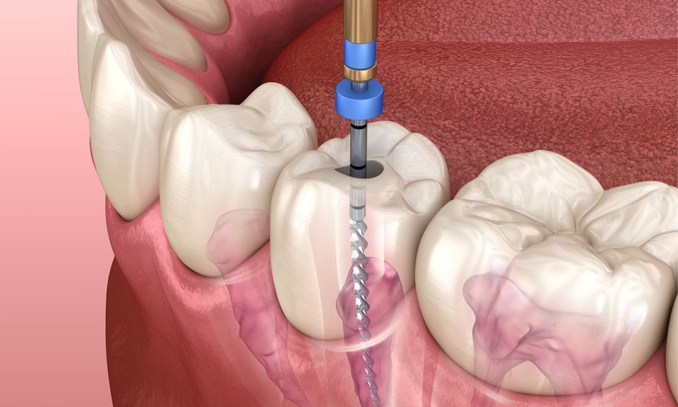 درمان عصب کشی مجدد دندان