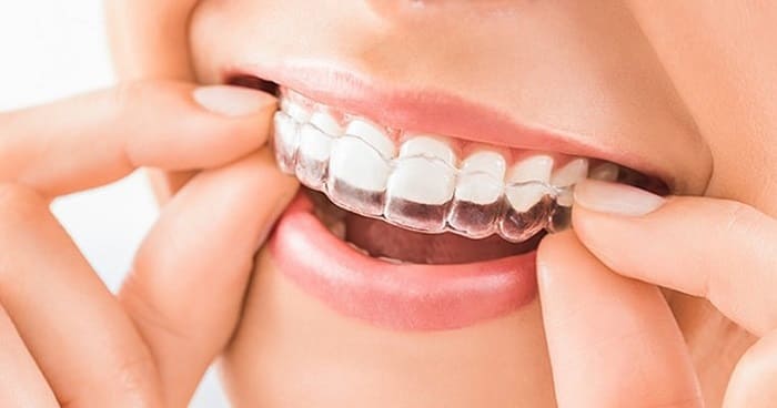 نایت گارد یا محافظ دهان شبانه