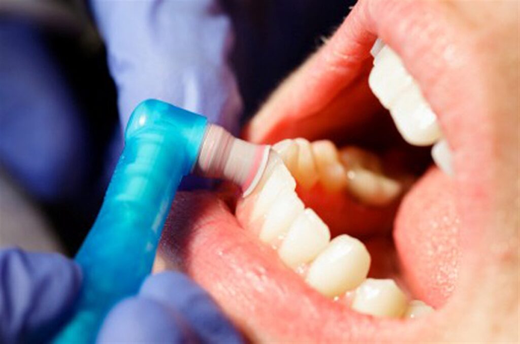 اهمیت از بین بردن جرم سیاه دندان