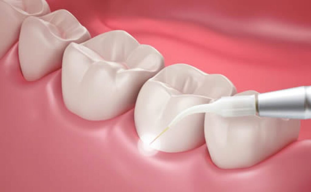 آیا بیمه هزینه پروتز دندان را پوشش می‌دهد؟