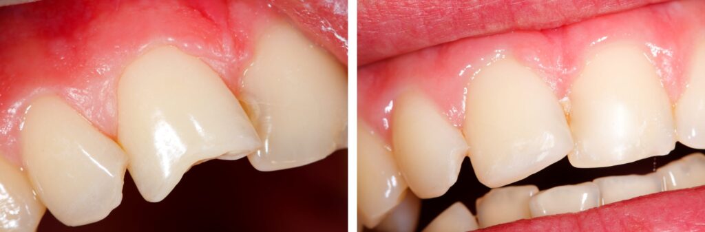 برای ترمیم دندان شکسته به کدام دندانپزشک مراجعه کنیم؟
