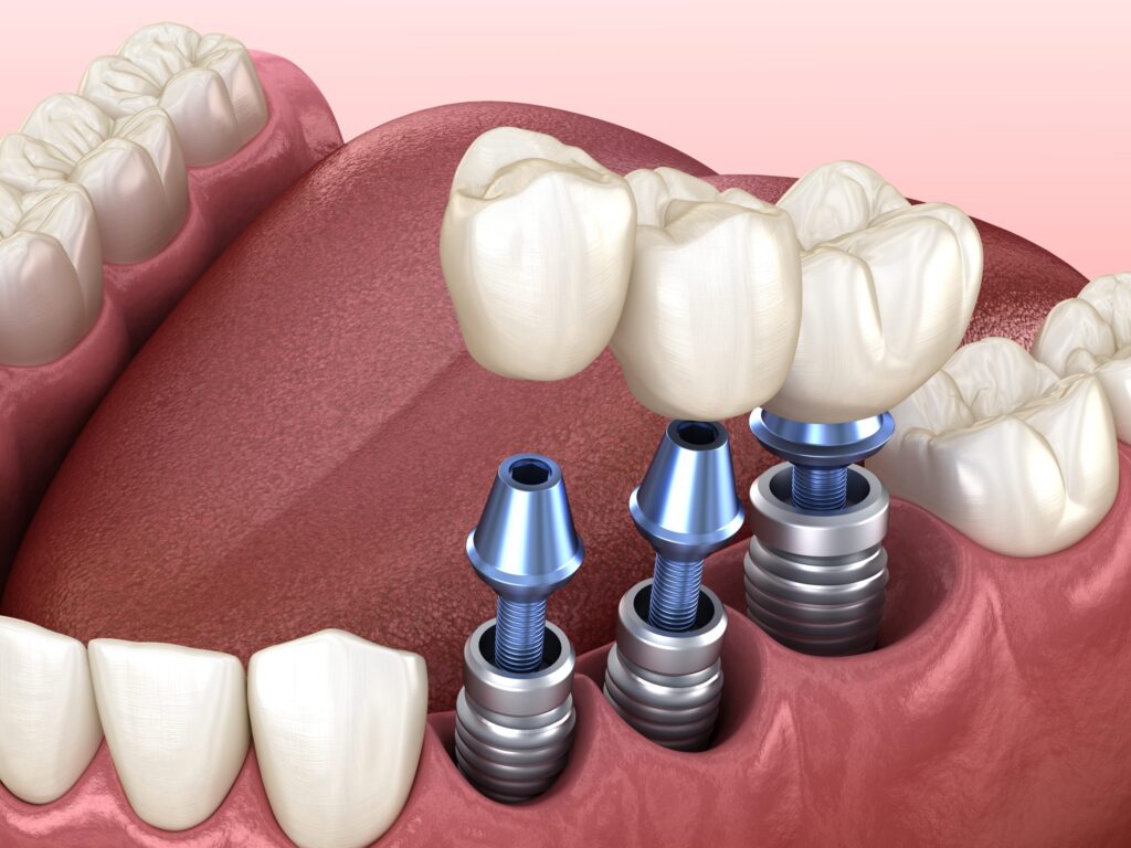 پروتز دیجیتال دندان چیست و چه تفاوتی با پروتزهای سنتی دارد؟