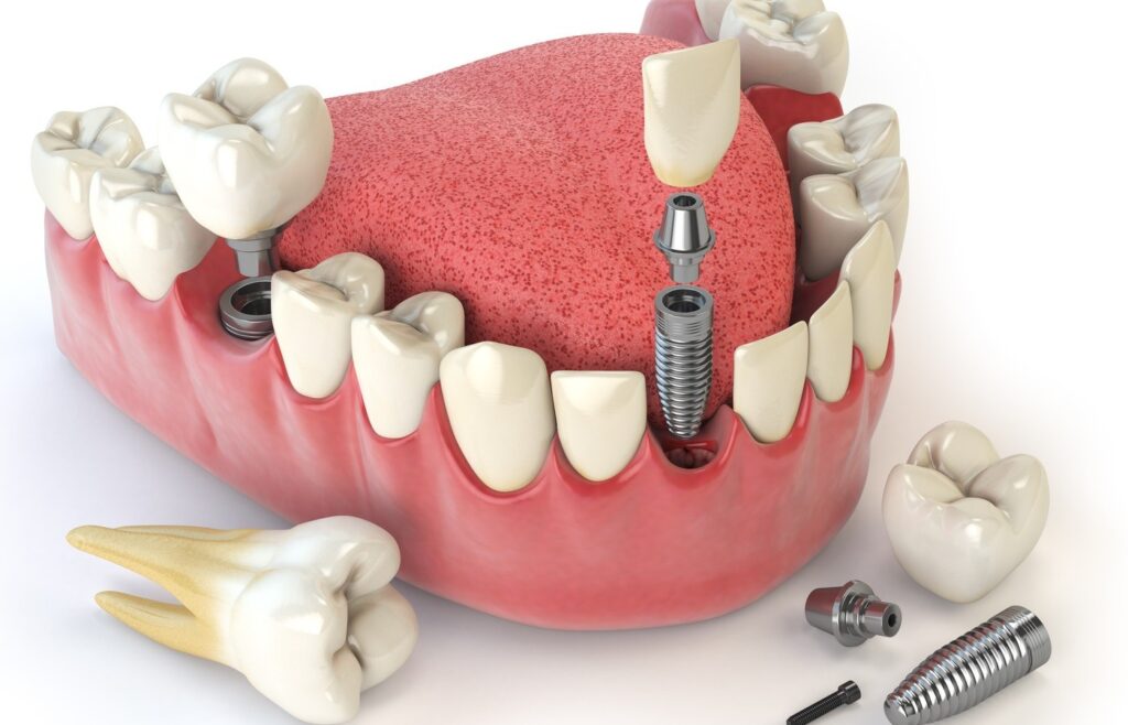 عوارض احتمالی ایمپلنت دندان: