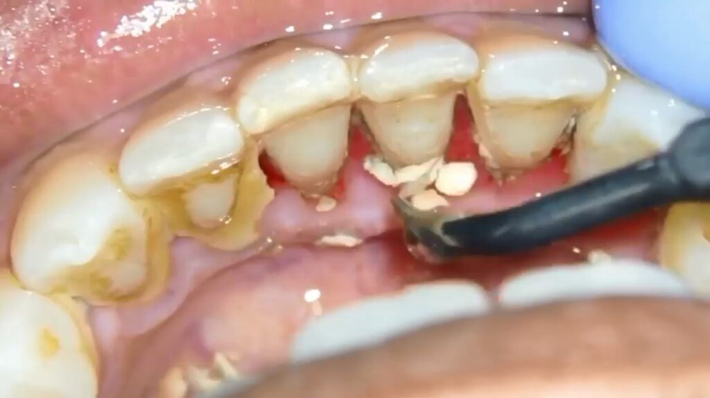 مهم‌ترین روش‌های جرم گیری دندان در منزل 