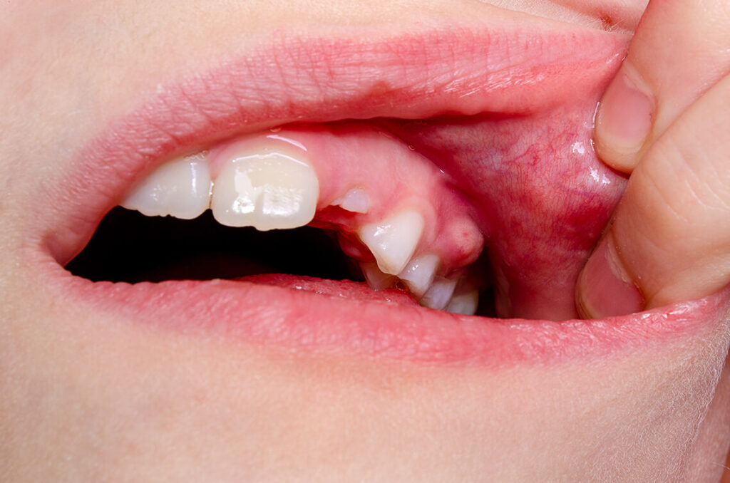 راه‌های خانگی برای درمان عفونت دندان چگونه است؟