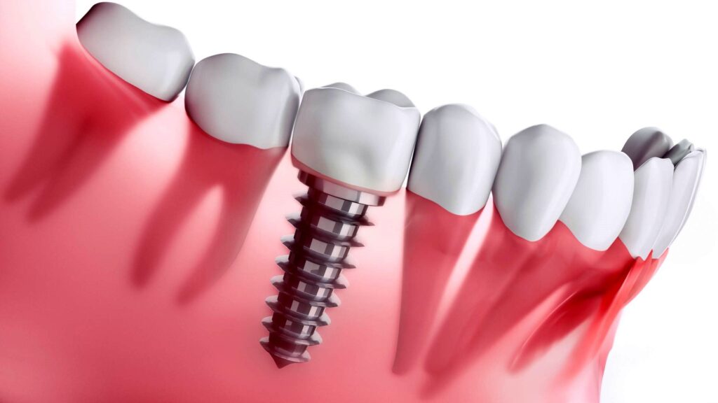 تفاوت بین ایمپلنت دندان و پروتز دندان چیست؟