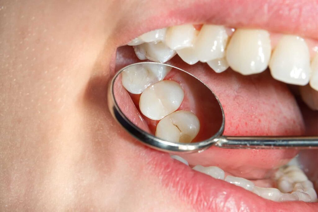 آخرین راه‌حل درمان دندان شکسته چیست؟