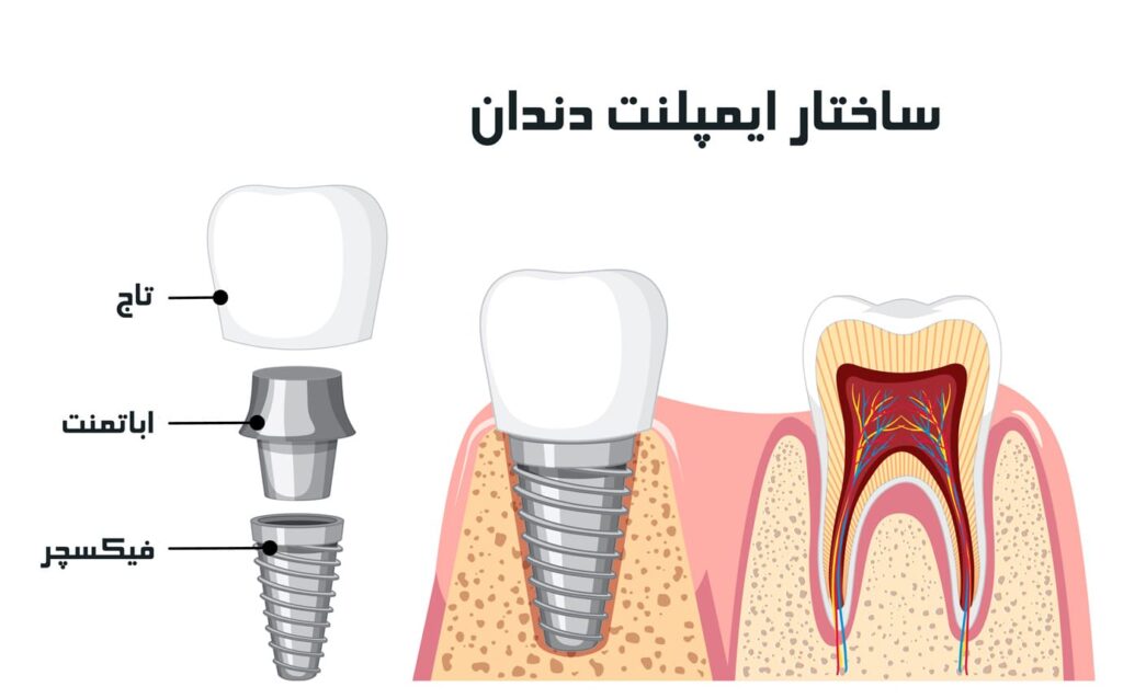 اباتمنت دندان