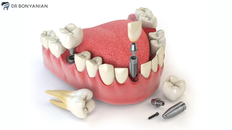 ایمپلنت دندان جلو چیست؟