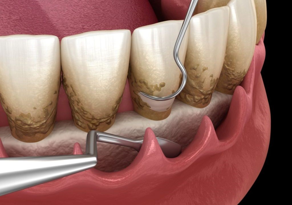 کورتاژ لثه چیست و به چه دلیل انجام می شود؟