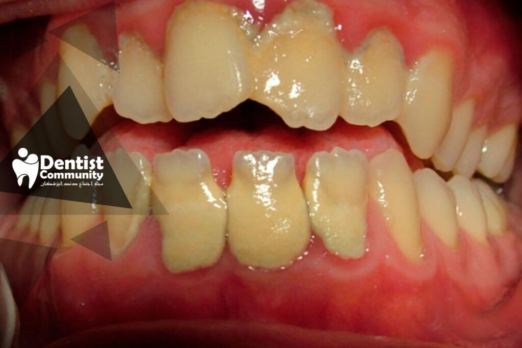 کمبود ویتامین D