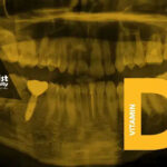 تأثیر کمبود ویتامین D بر پوسیدگی دندان‌ها و راهکارهای پیشگیری