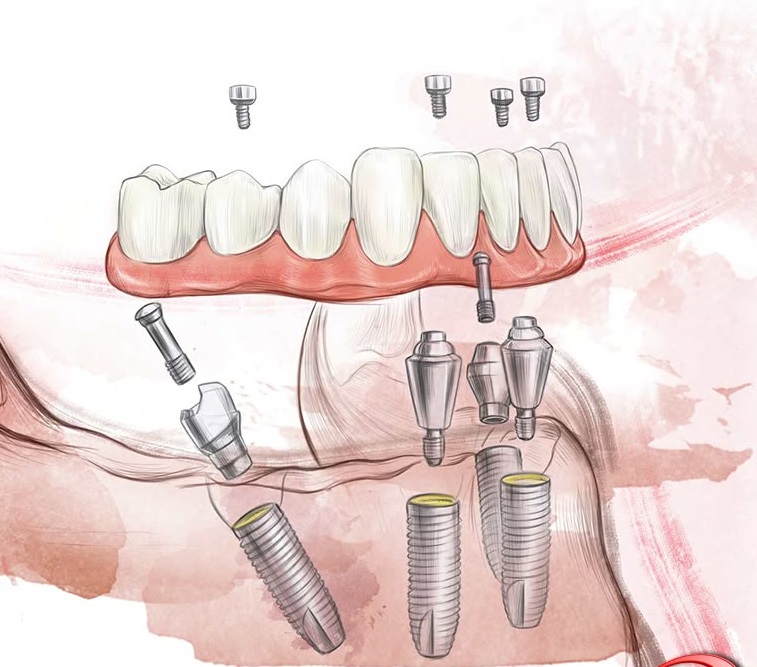 ایمپلنت دندان