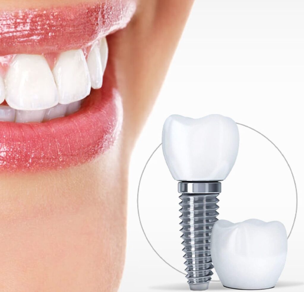 ایمپلنت دیجیتال