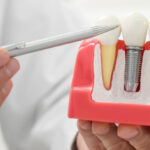 معرفی انواع ایمپلنت دندان؛ کدام ایمپلنت برای شما مناسب‌تر است؟