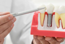 معرفی انواع ایمپلنت دندان؛ کدام ایمپلنت برای شما مناسب‌تر است؟