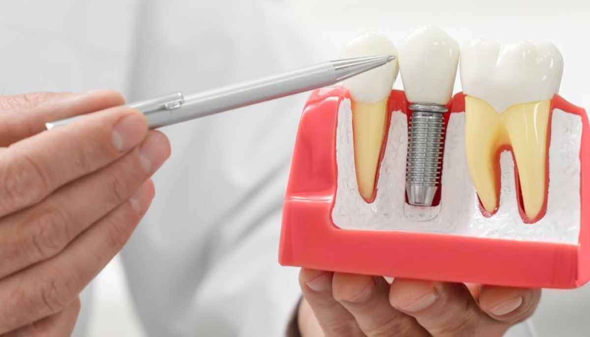 معرفی انواع ایمپلنت دندان؛ کدام ایمپلنت برای شما مناسب‌تر است؟