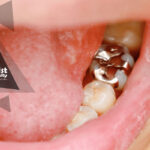 پایان استفاده از آمالگام دندانی تا سال 2034؛ تصمیم جهانی برای کاهش آلودگی جیوه و تأثیر آن بر دندانپزشکی