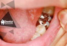 پایان استفاده از آمالگام دندانی تا سال 2034؛ تصمیم جهانی برای کاهش آلودگی جیوه و تأثیر آن بر دندانپزشکی