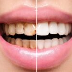 عوارض و معایب کامپوزیت دندان که کسی به شما نمی گوید