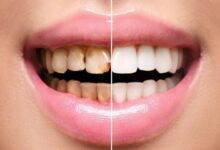 عوارض و معایب کامپوزیت دندان که کسی به شما نمی گوید