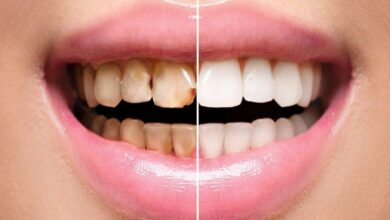 عوارض و معایب کامپوزیت دندان که کسی به شما نمی گوید