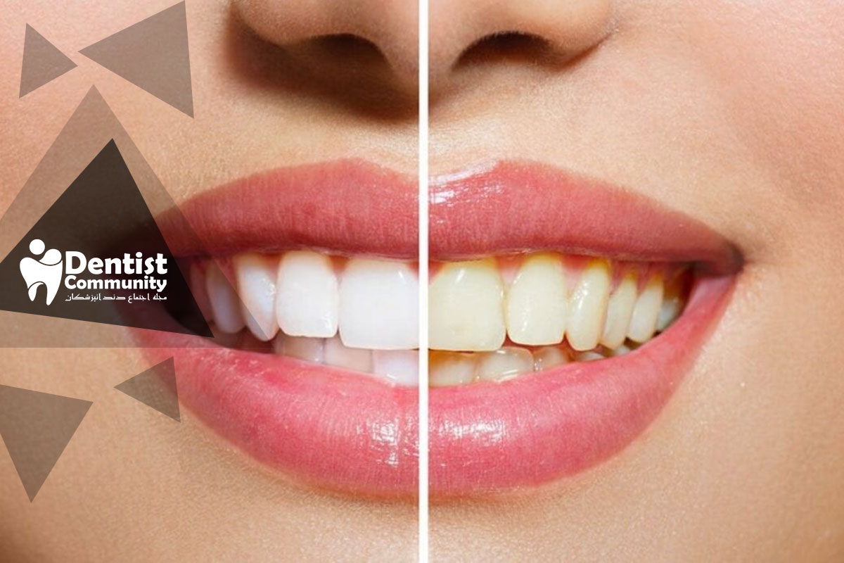 بهترین زمان مسواک زدن بعد از قهوه یا چای برای جلوگیری از لکه دندان و زردی مینای دندان