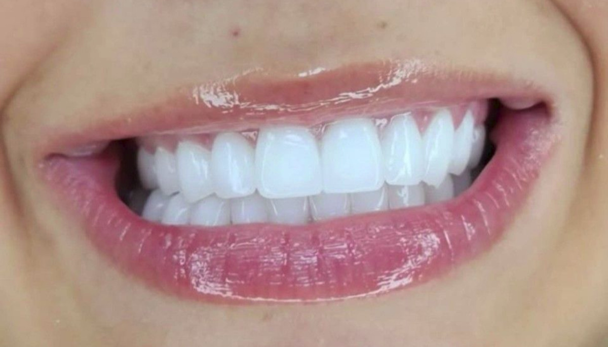 ونیر کامپوزیت چیست و چه مزایا و معایبی دارد؟