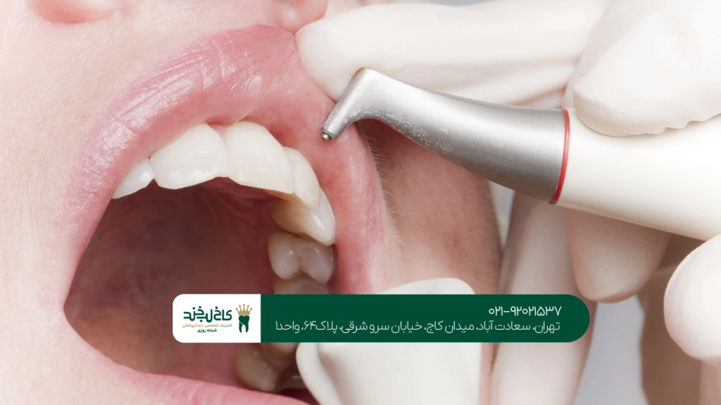 دندانپزشکی ایمپلنت