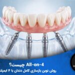 نتیجه درمان All-on-4 (بازسازی کامل دندان)