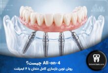 نتیجه درمان All-on-4 (بازسازی کامل دندان)