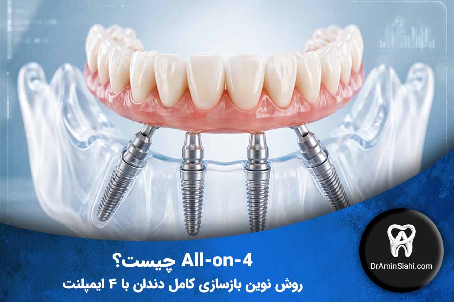 نتیجه درمان All-on-4 (بازسازی کامل دندان)